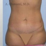 Abdominoplasty Before & After Patient #8172