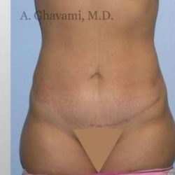 Abdominoplasty Before & After Patient #8172