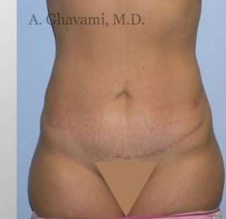 Abdominoplasty Before & After Patient #8172