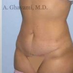 Abdominoplasty Before & After Patient #8172