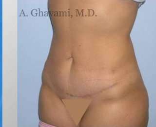 Abdominoplasty Before & After Patient #8172
