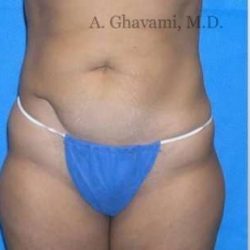 Abdominoplasty Before & After Patient #8172