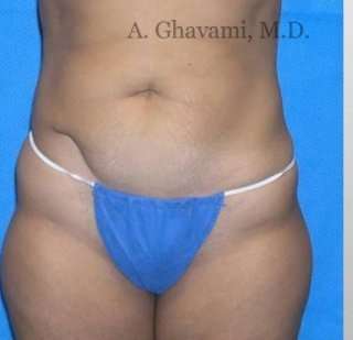 Abdominoplasty Before & After Patient #8172