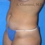Abdominoplasty Before & After Patient #8172