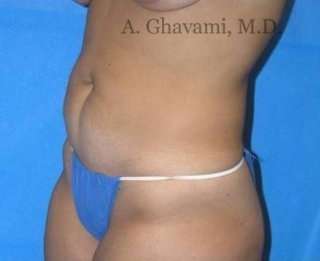 Abdominoplasty Before & After Patient #8172