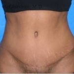 Abdominoplasty Before & After Patient #8167
