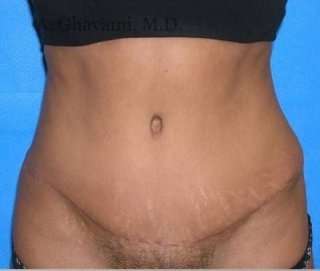 Abdominoplasty Before & After Patient #8167