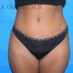 Abdominoplasty Before & After Patient #8167