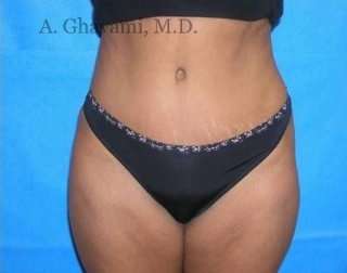 Abdominoplasty Before & After Patient #8167