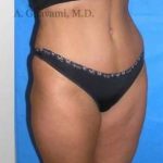 Abdominoplasty Before & After Patient #8167