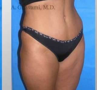 Abdominoplasty Before & After Patient #8167