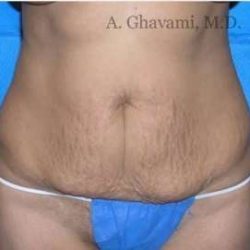 Abdominoplasty Before & After Patient #8167