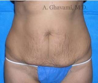 Abdominoplasty Before & After Patient #8167