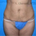 Abdominoplasty Before & After Patient #8167