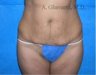 Abdominoplasty Before & After Patient #8167
