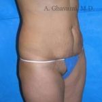 Abdominoplasty Before & After Patient #8167