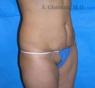 Abdominoplasty Before & After Patient #8167