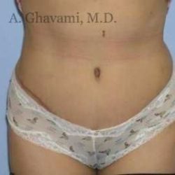 Abdominoplasty Before & After Patient #8160