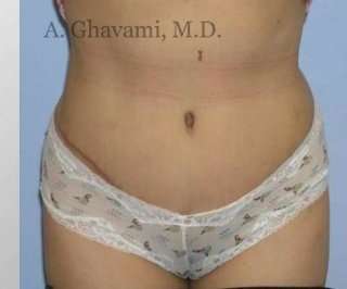 Abdominoplasty Before & After Patient #8160