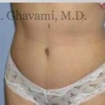 Abdominoplasty Before & After Patient #8160