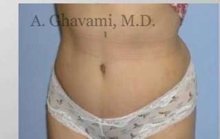 Abdominoplasty Before & After Patient #8160