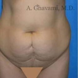 Abdominoplasty Before & After Patient #8160