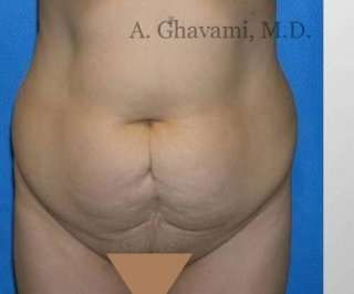 Abdominoplasty Before & After Patient #8160