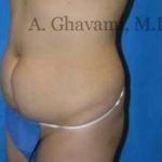 Abdominoplasty Before & After Patient #8160