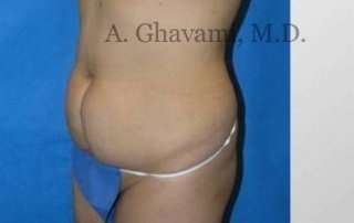 Abdominoplasty Before & After Patient #8160