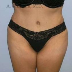 Abdominoplasty Before & After Patient #8155