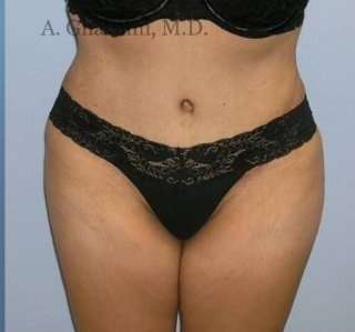 Abdominoplasty Before & After Patient #8155