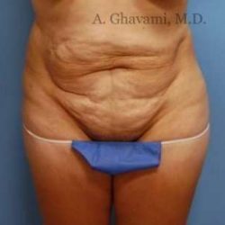 Abdominoplasty Before & After Patient #8155