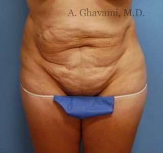 Abdominoplasty Before & After Patient #8155