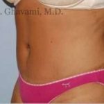 Abdominoplasty Before & After Patient #8152