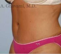 Abdominoplasty Before & After Patient #8152