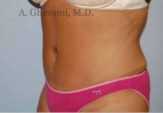 Abdominoplasty Before & After Patient #8152