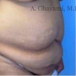 Abdominoplasty Before & After Patient #8152