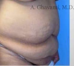 Abdominoplasty Before & After Patient #8152