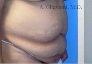 Abdominoplasty Before & After Patient #8152