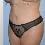 Abdominoplasty Before & After Patient #8149