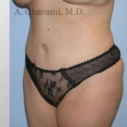 Abdominoplasty Before & After Patient #8149