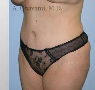 Abdominoplasty Before & After Patient #8149