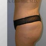 Abdominoplasty Before & After Patient #8149