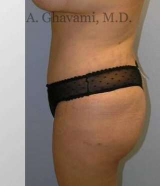 Abdominoplasty Before & After Patient #8149