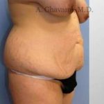 Abdominoplasty Before & After Patient #8149