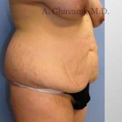 Abdominoplasty Before & After Patient #8149