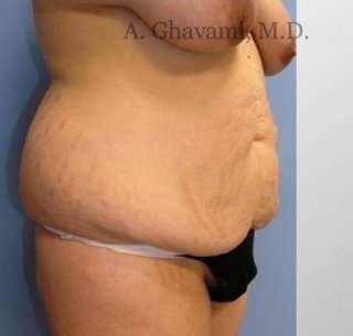 Abdominoplasty Before & After Patient #8149