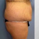 Abdominoplasty Before & After Patient #8149