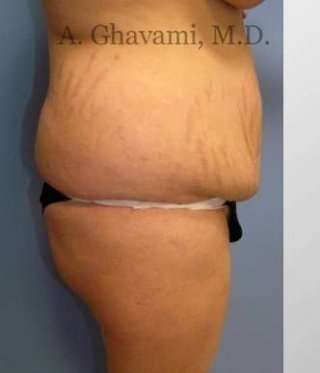 Abdominoplasty Before & After Patient #8149