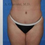 Abdominoplasty Before & After Patient #8144